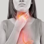 Acid Reflux