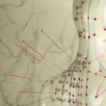 acupuncture