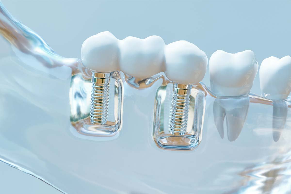 dental implant